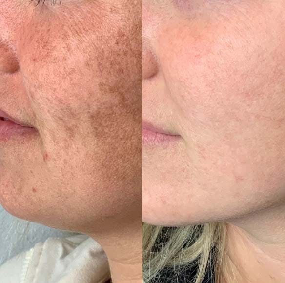 Antes & Depois — Melasma e tom uniforme