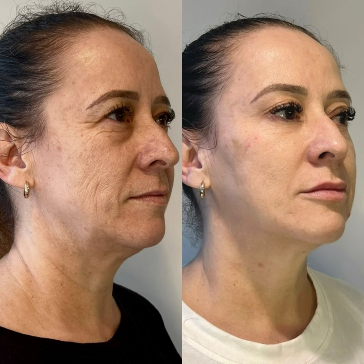 Antes & Depois — Textura e elasticidade