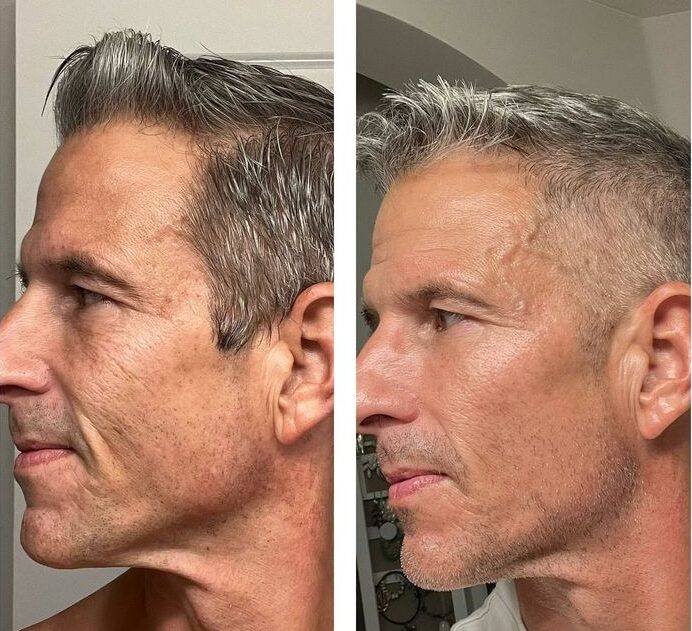 Antes e depois após 6 meses: linhas suavizadas, pele com aspecto mais firme e saudável em homem