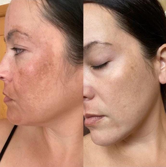 Antes e depois após 6 meses: aparência do melasma mais uniforme e pele luminosa