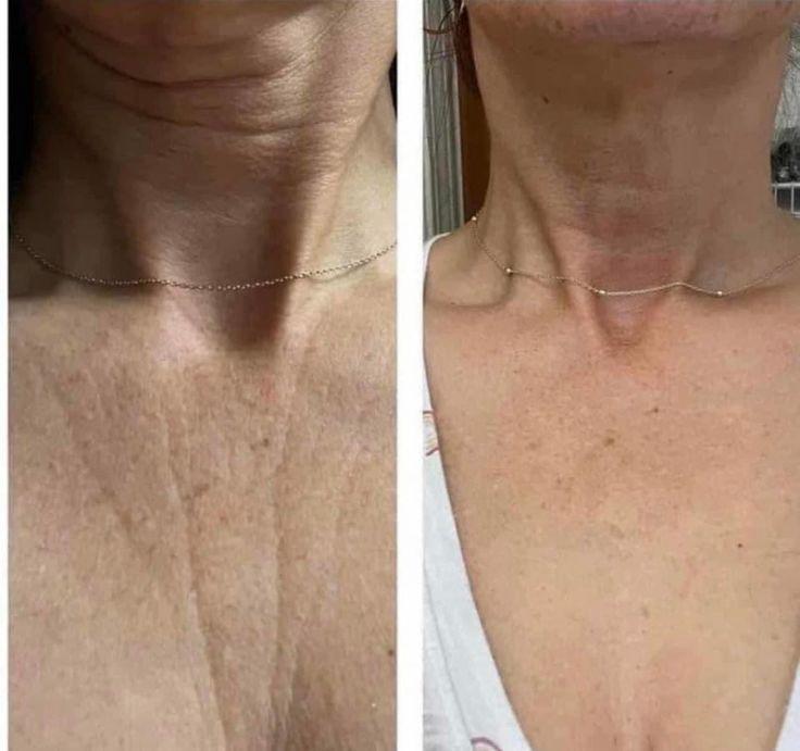 Antes e depois após 4 meses: rugas no colo suavizadas, pele mais lisa e hidratada