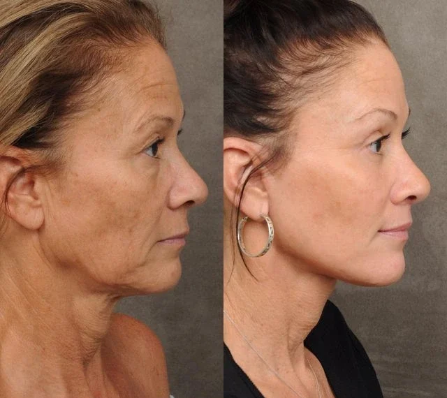 Antes e depois após 6 meses