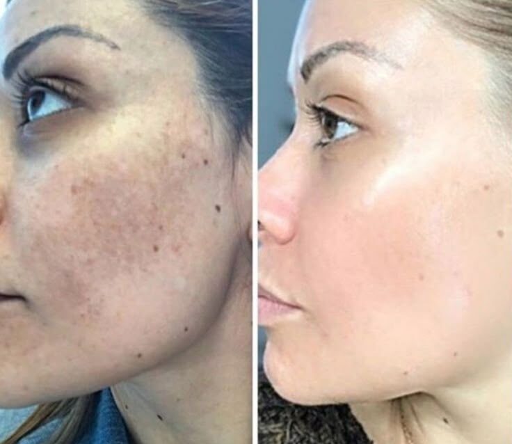 Antes e depois após 6 meses