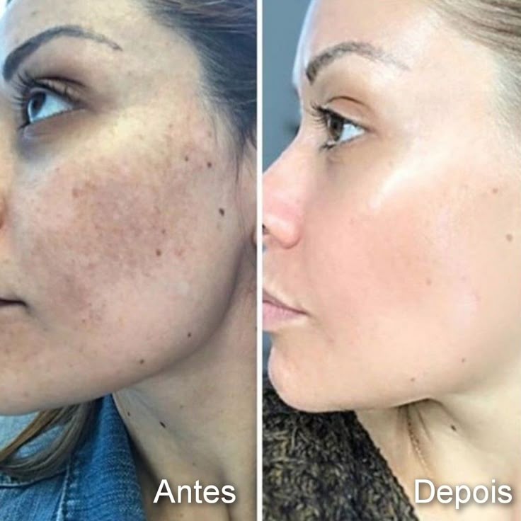 Antes e depois após 6 meses: melhora na uniformidade do tom e aparência do melasma