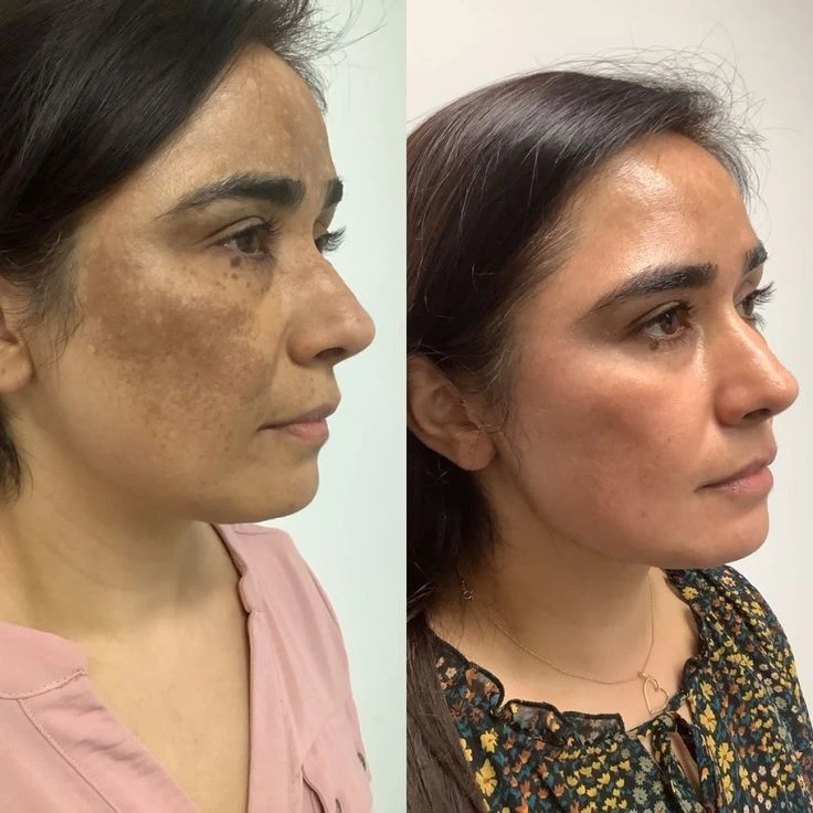 Resultado visível no melasma — Carolina