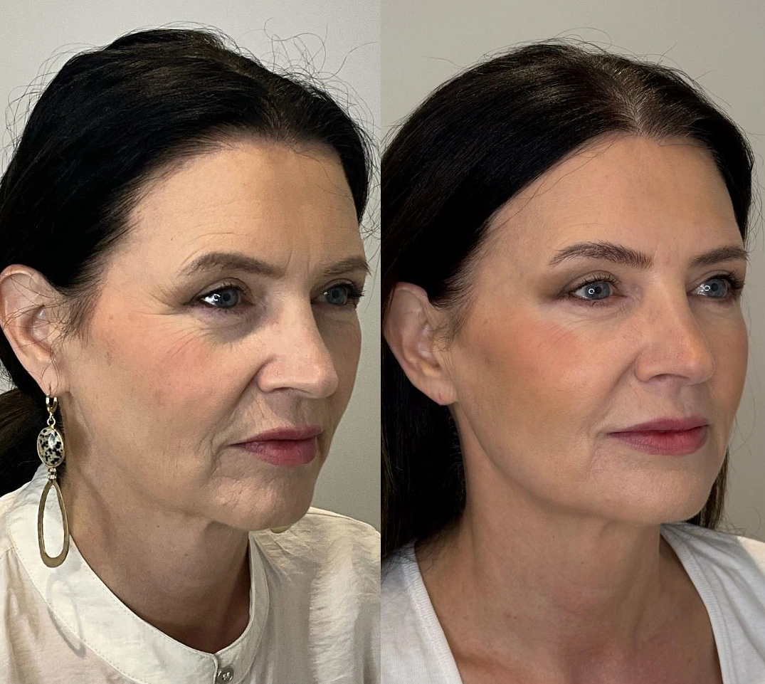 Antes e depois após 12 meses