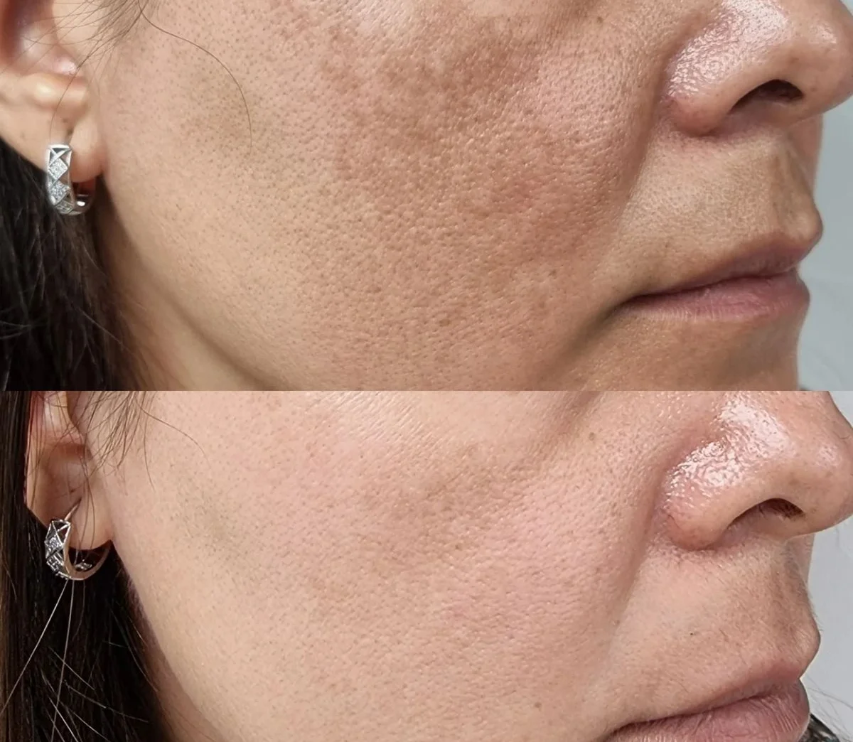 Antes e depois após 6 meses