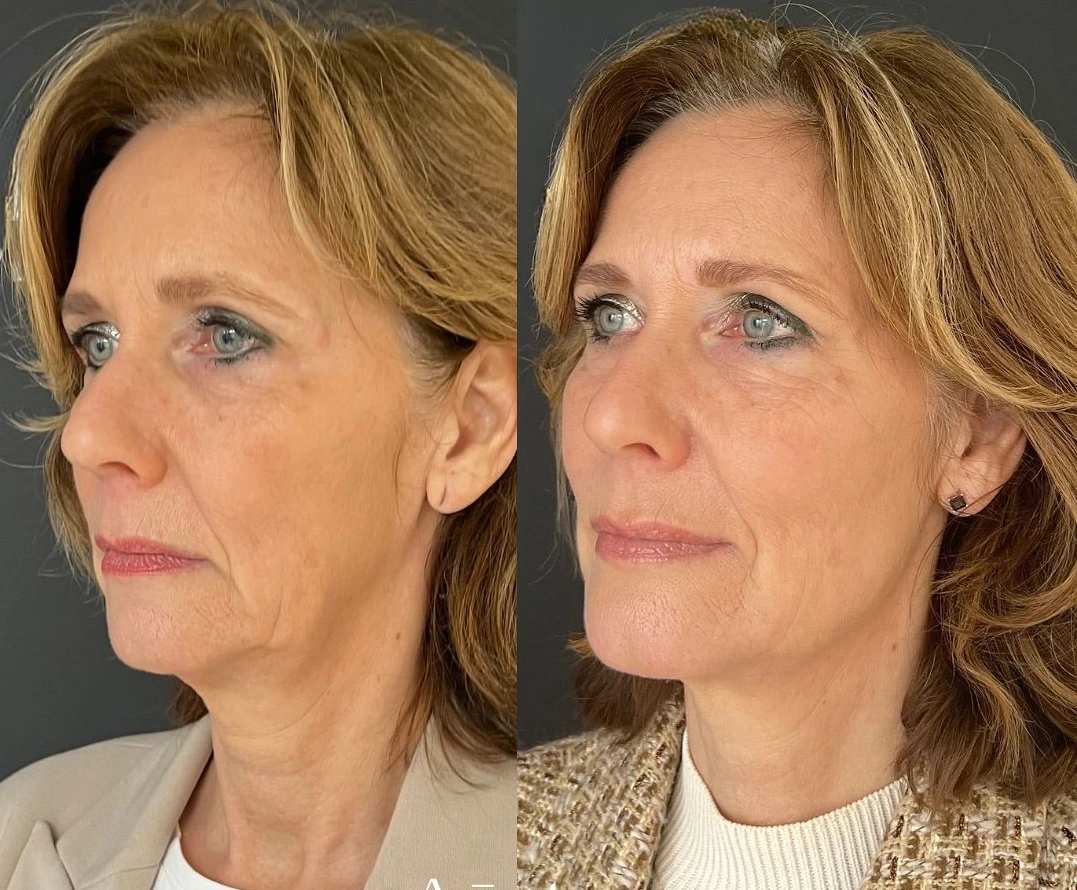 Antes e depois (90 dias) — Maria Clara