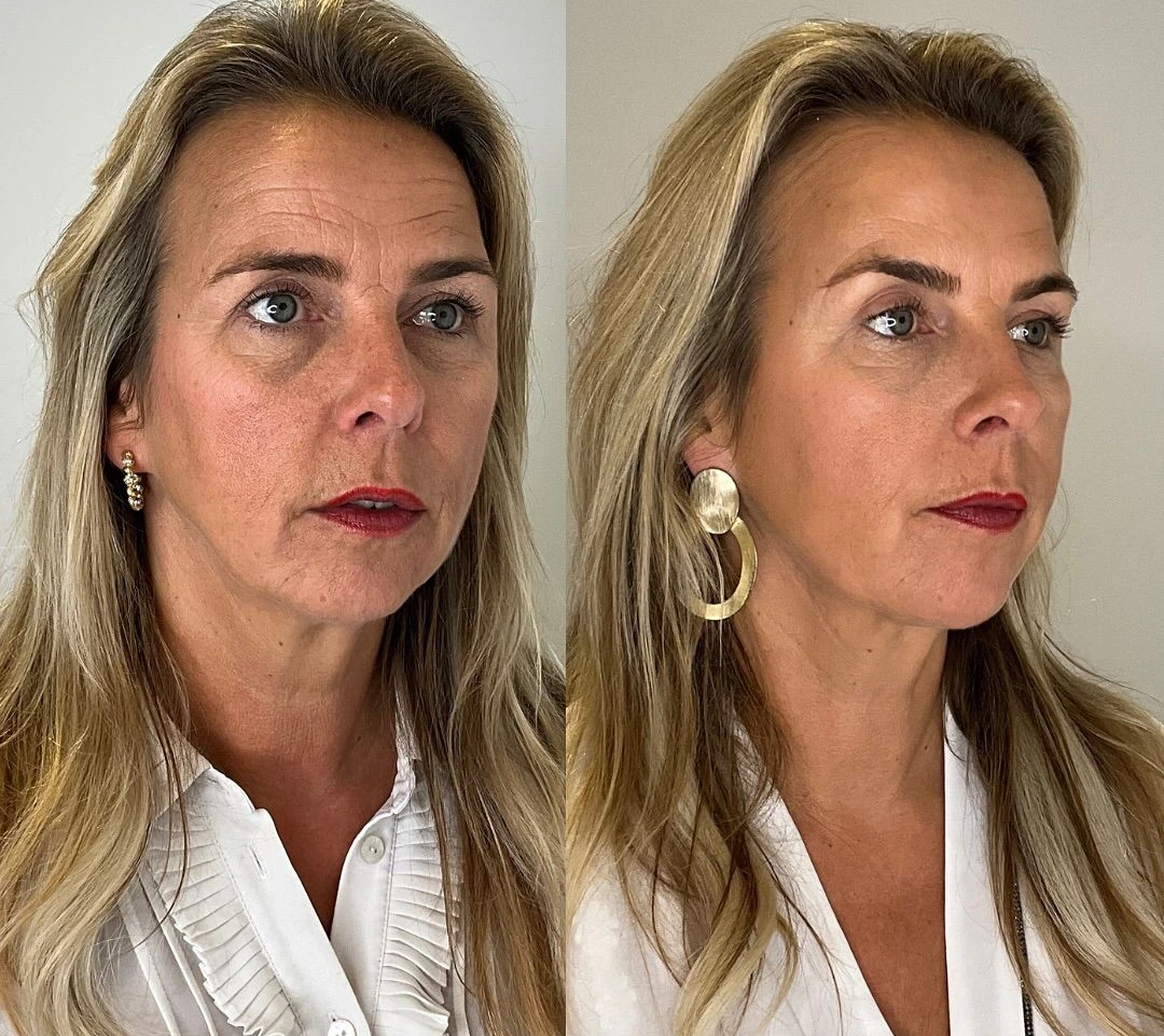 Antes e depois após 4 meses