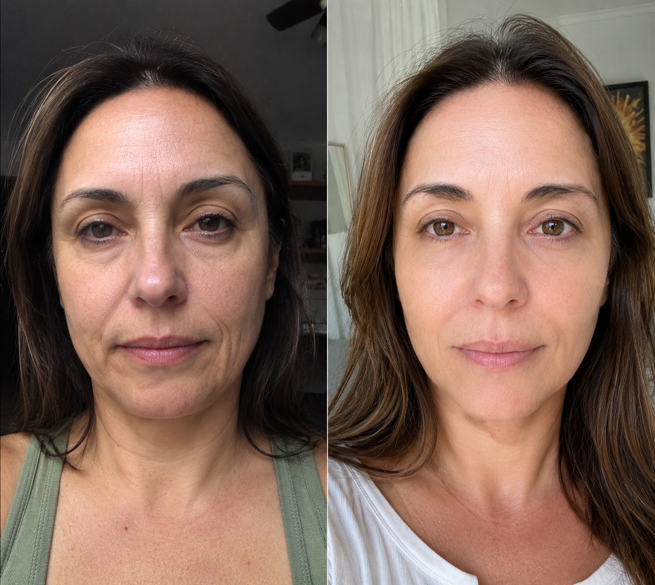 Antes e depois após 4 meses